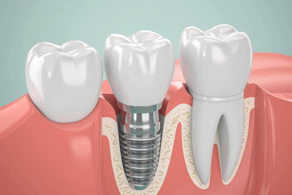 Cross section of the jaw with an embedded dental implant in the gum. Dental surgery for teeth restoration. Dentistry and tooth care concept